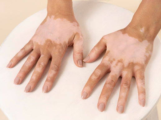 TCM-Treatment-for-Vitiligo